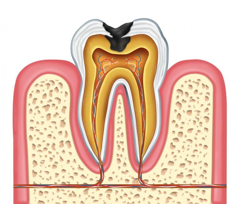 caria dentara