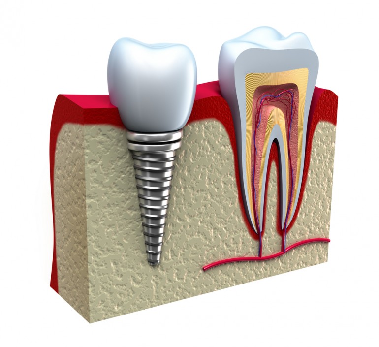 implant dentar