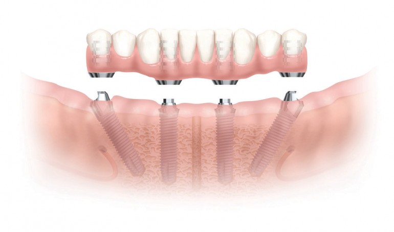 implant dentar