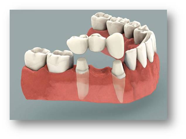 punte dentara