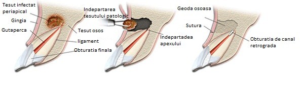 rezectie apicala explicata