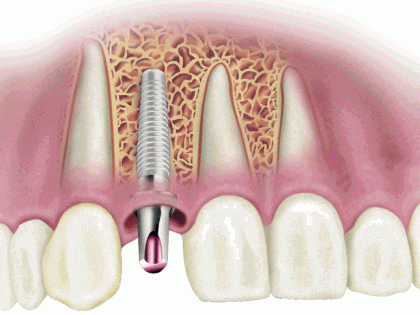 Intrebari frecvente – implant dentar