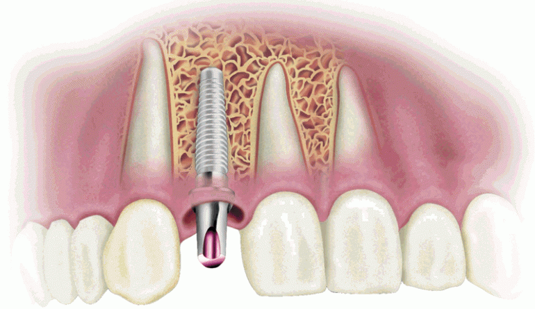 implant dentar